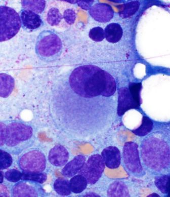 Abnormal megakaryocyte